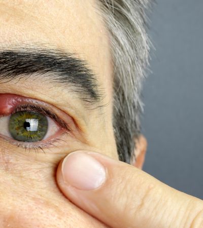 Blefaritis i mussols: 7 consells útils per evitar la inflamació de les parpelles