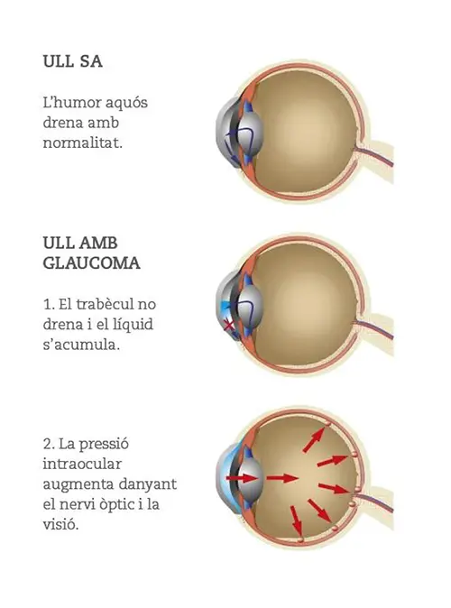 Glaucoma-4