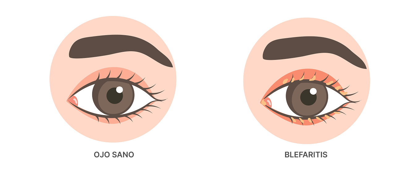 Blefaritis: cómo controlar esta inflamación crónica de los párpados