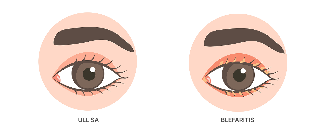 Blefaritis: com controlar aquesta inflamació crònica de les parpelles