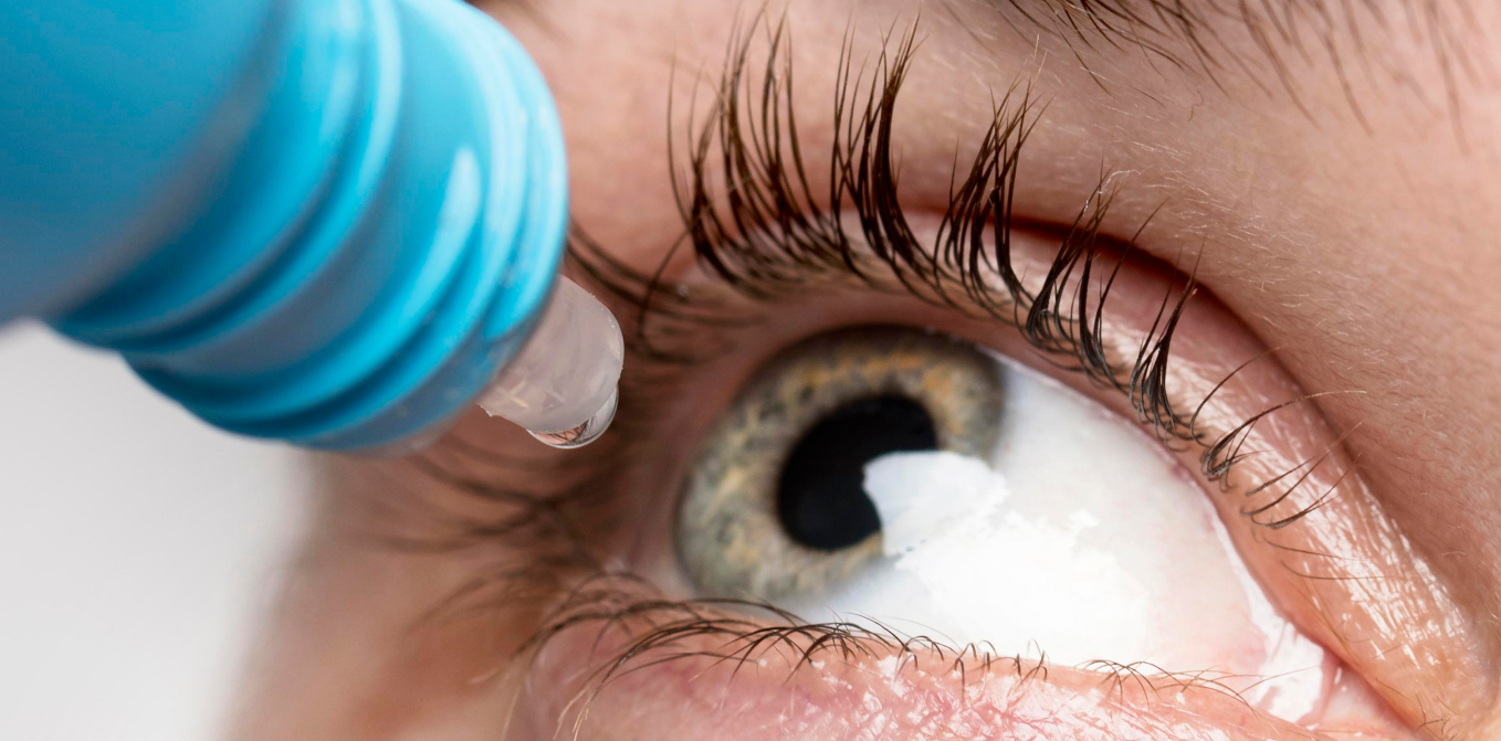 Gotas oculares aplicándose en el ojo para aliviar la irritación por alergia primaveral.