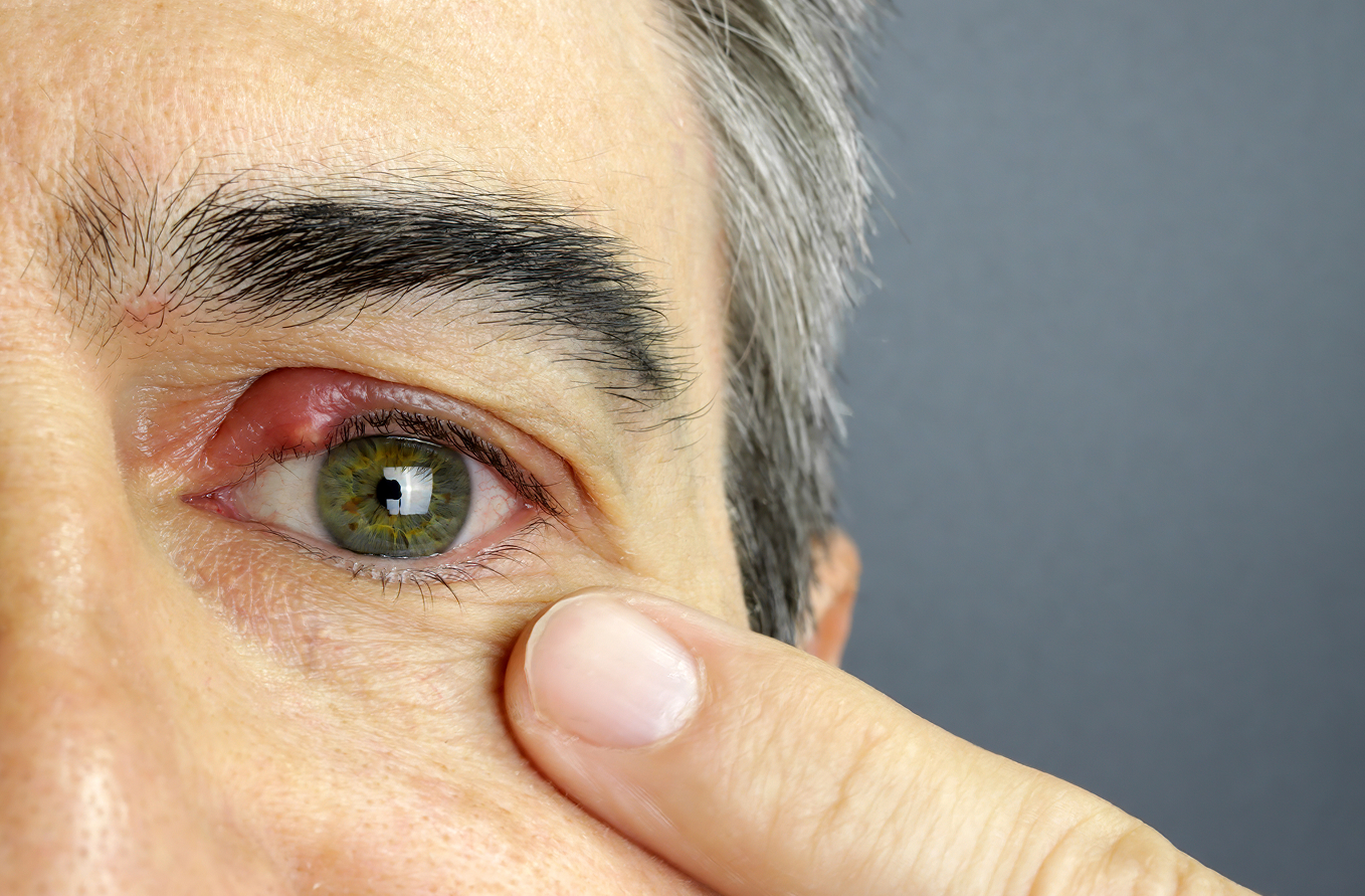 ojo con un orzuelo en el párpado, una inflamación habitual relacionada con la blefaritis.