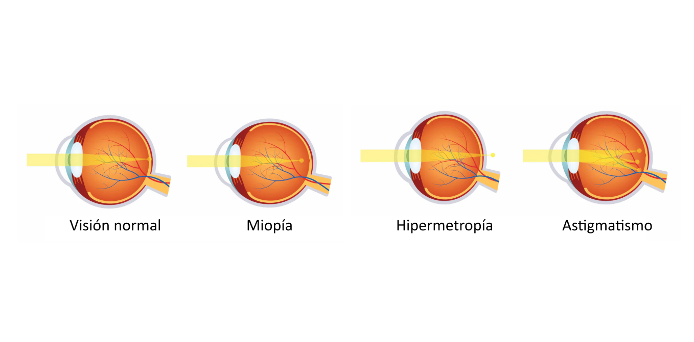 Diagrama comparativo de la visión normal con miopía, hipermetropía y astigmatismo.