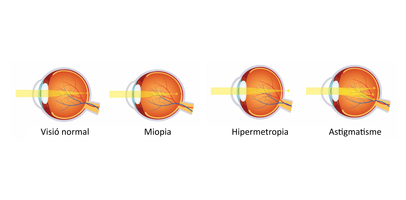 Diagrama comparatiu de la visió normal amb miopia, hipermetropia i astigmatisme. 