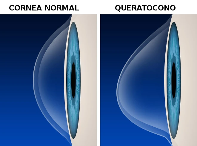 Cornea queratocono