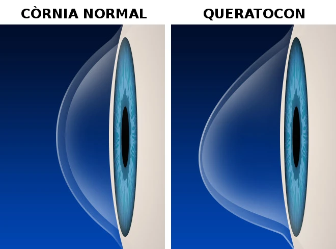 Còrnia queratocon