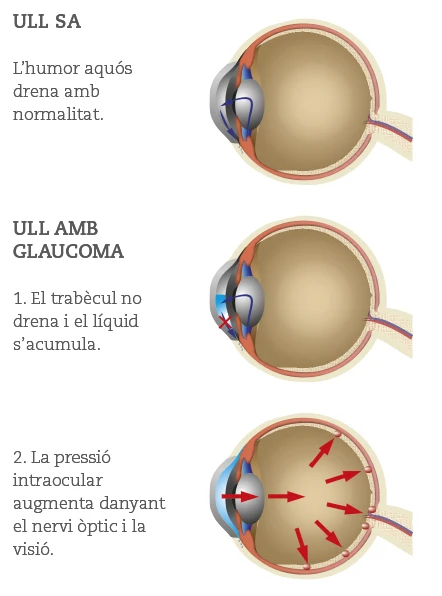 Ull Glaucoma