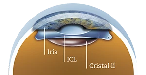 ICL