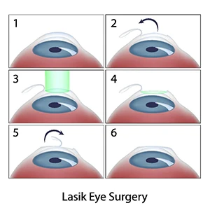 Lasik Eye Surgery