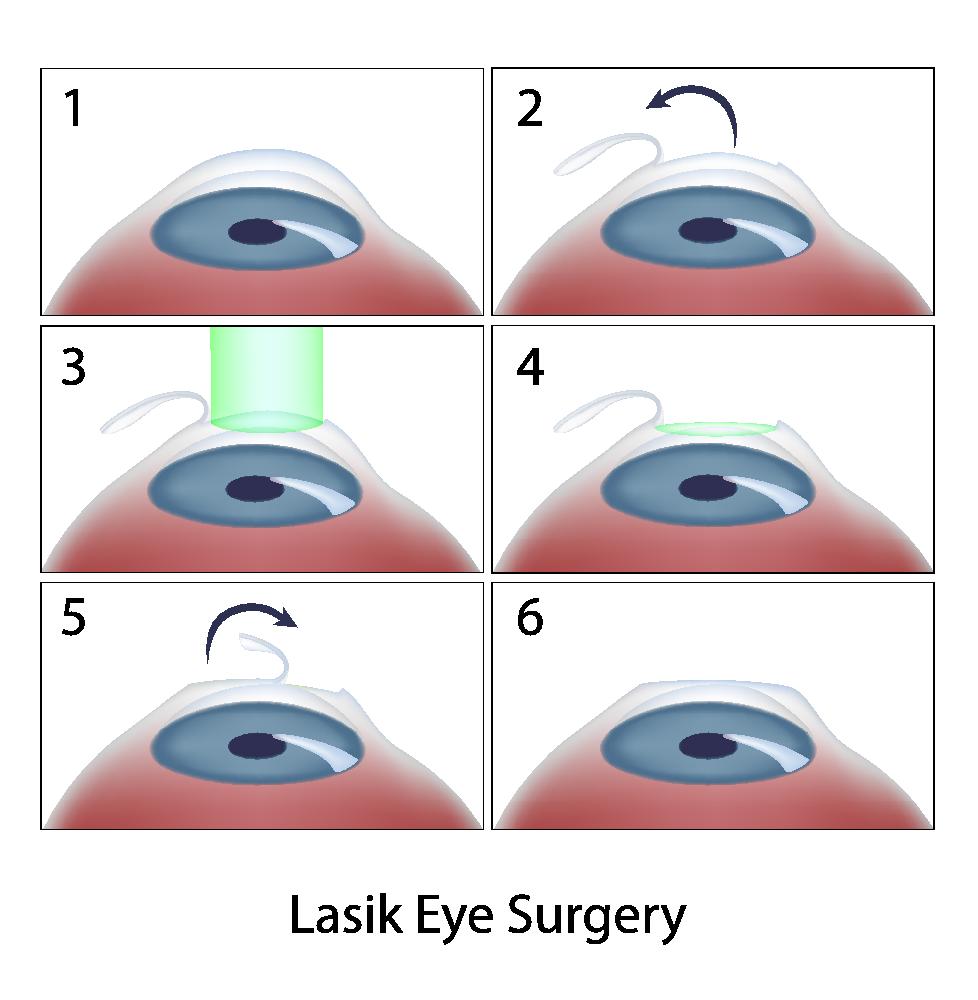 lasik-eye